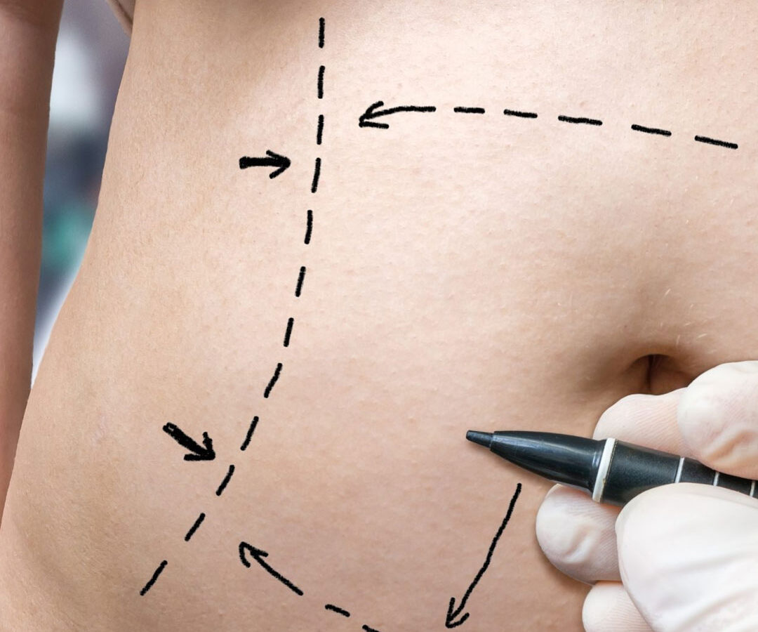 Cobertura de cirurgia plástica reparadora a pacientes de bariátrica
