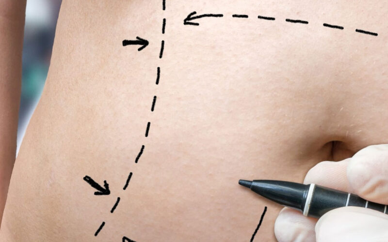 Cobertura de cirurgia plástica reparadora a pacientes de bariátrica